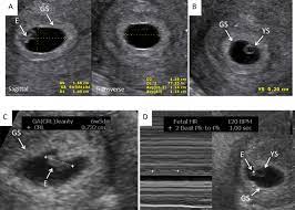 Check spelling or type a new query. Early Pregnancy Ultrasound Measurements And Prediction Of First Trimester Pregnancy Loss A Logistic Model Scientific Reports