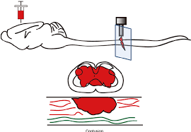 Image result for Contusion