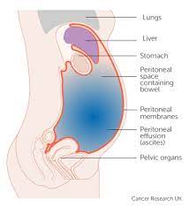 According to cancer research uk's statistics, a quarter of warning signs. Symptoms Liver Cancer Cancer Research Uk