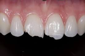 Image result for Tooth Fracture