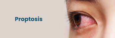 Image result for Proptosis