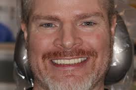 Advantages of ArchONE's Full Arch Implant System