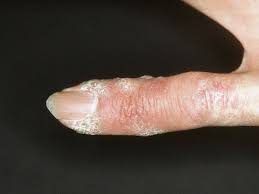The butchers for example present as a. Tuberculosis Cutis Verrucosa Altmeyers Enzyklopadie Fachbereich Dermatologie