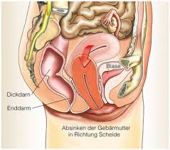 Gebarmuttersenkung Definition Symptome Therapie