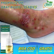 Bintik merah pada kulit bisa menjadi pertanda adanya penyakit infeksi. Propolis 6ml Obat Kudis Alami Kudis Kurap Kudis Bernanah Penyakit Kudis Menahun Scabies Pengobatan Kudis Di Kepala Tangan Kaki Lutut Ketiak Selangkangan Hidung Leher Kelamin Paling Bagus Lazada Indonesia