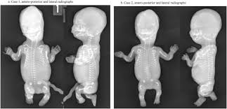Prognosis the prognosis depends on the presence and severity of the immune deficiency and the possible association. Early Prenatal Presentation Of The Cartilage Hair Hypoplasia Anauxetic Dysplasia Spectrum Of Disorders Mimicking Recurrent Thanatophoric Dysplasia Sciencedirect