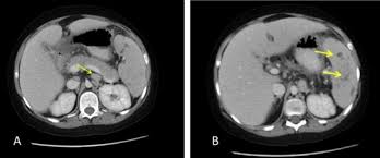 Lymph nodes & spleen, nonlymphoma. Childhood Systemic Sarcoid Like Necrotizing Granulomatous Disease Another Piece Of The Puzzle Sciencedirect