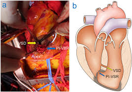Image result for Ventricular Septal Defect