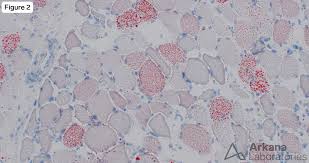 Image result for Myopathy