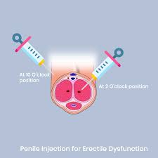 PRP Injection for bigger penis – does it work? – Sexologists in Chennai  treating Mens Infertility (Premature Ejaculation, Erection Problems etc)  since 28 years