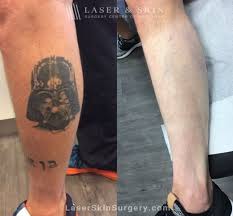 Sleep easy at night knowing that your dermabrasion procedures are covered under our exclusive medical spa insurance programs for tattoo removal clinics. Why You Should Come To Us For Tattoo Removal Laser Ny