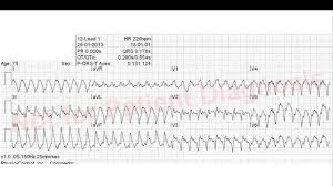 Svt klinikte genellikle düzenli, dar veya geniş qrs kompleksi bir ritm olarak karşımıza çıkmakla. 5 Minuten Innere Ventrikulare Tachykardie Youtube