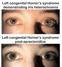 Horner S Syndrome Case Based Neuro Ophthalmology