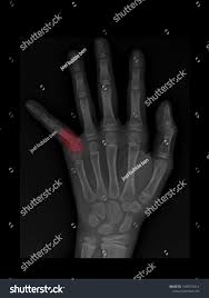 Image result for Hand Growth Plates