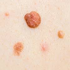 Two new studies find an association between breast cancer and moles. Melanoma Pictures Symptoms What Does Melanoma Look Like