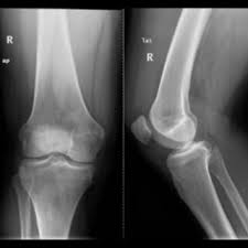 Image result for Knee XRay