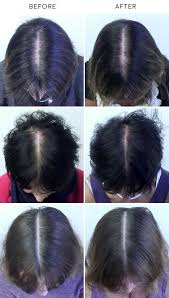 It strengthens the hair follicles, making the hair roots stronger. Black Currant Oil Hair Loss Growth Before And After Pictures Hair Loss Remedies Reduce Hair Loss Hair Problems