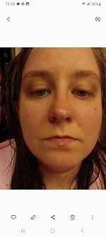 Hi all, I have recently been diagnosed with HH after initially presenting  with a rash