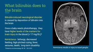 Image result for Kernicterus