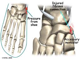 Physical Therapy In Erie For Accessory Navicular Problems