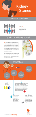 Kidney Stones Are Not Fun My Story And Infographic Robyns World Kidney Stones Kidney Stone Diet Kidney Health