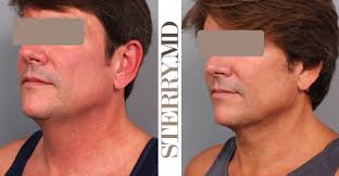 The cost of the chin liposuction procedures will depend on the size of the chosen area and the time required to perform the procedure. What S Best For Double Chin Removal Plastic Surgery News For New York City From Dr Thomas P Sterry