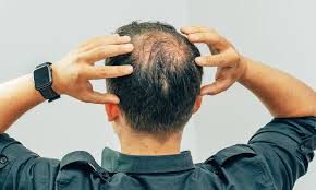 Learn more about hair loss and find the best hair loss treatment. There S A New Remedy For Hair Loss But You Ll Need A Strong Stomach To Tolerate It Daily Mail Online