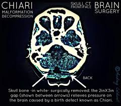 Brain Srgery Srvivor Audreyterp Twitter Chiari Chiari Malformation Brain
