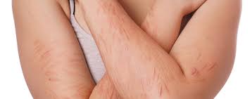 How does an acne scar form? Treating Self Harm Scars You Don T Have To Live With Those Scars