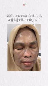 Akibat cream abal-abal, wajah jadi rusak parah 😔, Bu Ida nggak pernah  nyangka kulitnya bisa sampai separah itu. Tapi pelan-pelan, setelah rutin  pakai rangkaian Natural In Cosmetic, kulit mulai membaik ...