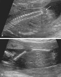 Ultrasound Features Of Fetal Syndromes Radiology Key