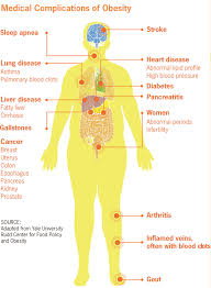 difference between obesity and morbid obesity difference