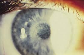 Corneal Ulcer: Symptoms, Causes & Treatment
