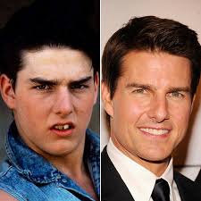 Tom cruise smile which looks as dashing today was not always that perfect. Celebrities Before And After Dental Work