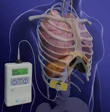 Expanding Diaphragm Respiratory Pacing University Hospitals
