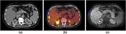 Check to see if your cancer has come back after successful treatment. Tumour Markers And Their Utility In Imaging Of Abdominal And Pelvic Malignancies Sciencedirect