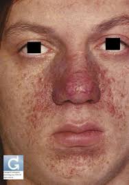 Global Dermatology » Tuberous Sclerosis (TSC)