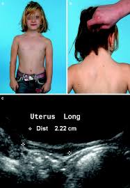 Image result for Precocious Puberty