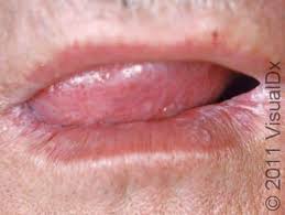 Image result for oral thrush symptoms roof of the mouth