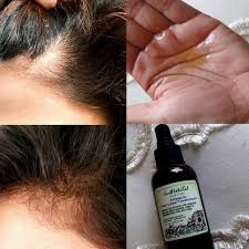 Natural treatments for alopecia with garlic. Alopecia Renewal Hair Scalp Therapy Hair Treatment Alopecia Hair Loss Treatment Hair Loss Treatment