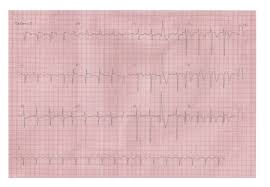 Image result for Left Axis Deviation