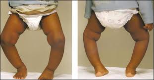 Image result for holistic way for bow legs