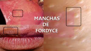 Manchas de Fordyce: ¿Qué son? – Prixz