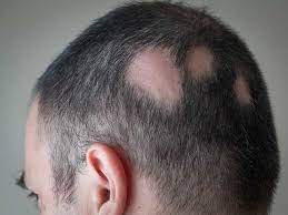 I have been very stressed from april this year onward, and have noticed. Losing Hair In Strange Places It Could Be Alopecia Areata