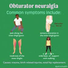 Image result for Obturator Nerve Compression