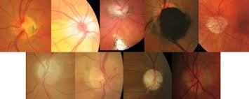 Optic nerve infarction is encountered in different settings, but is often divided into two categories Lesson Are You Missing These Optic Nerve Disorders