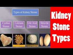 How To Get Rid Of Kidney Stones At Home Fast With Natural Remedies 2017 Kidney Stones Kidney Kidney Stones Remedy