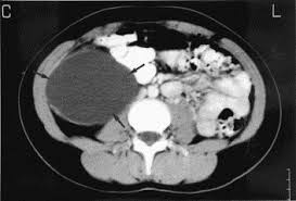 We did not find results for: Retroperitoneal Mucinous Cystadenoma European Journal Of Obstetrics And Gynecology And Reproductive Biology