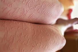 Image result for Dermatographism