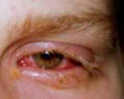 Sjs is generally triggered by medications (e.g., cert. Schwere Arzneimittelinduzierte Hautreaktionen Springerlink